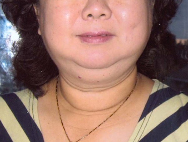 A pajzsmirigyrákkal diagnosztizált nő elmondta, mi volt az első ijesztő tünete, amit az orvosok nem vettek komolyan