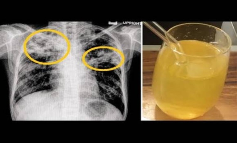 Így távolítsd el a lerakódott váladékot a légutakból természetesen