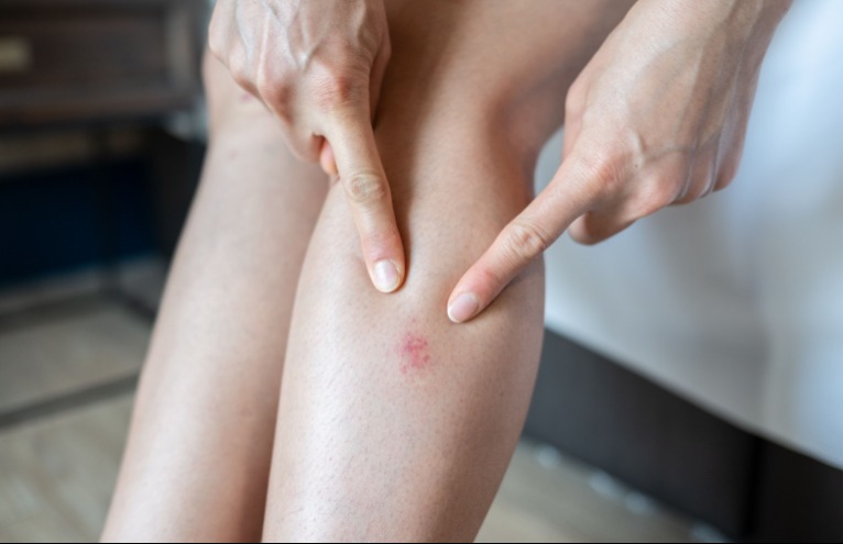 A kezeden és a lábadon is észreveheted a csendes gyilkos jeleit