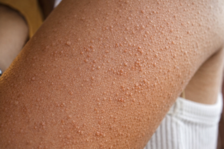 A „csendes gyilkos”, ami akár több ezer magyar embert is érinthet!