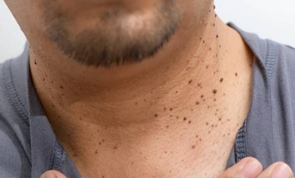 9 korai jele annak, hogy cukorbeteg vagy, de mit sem tudsz róla!