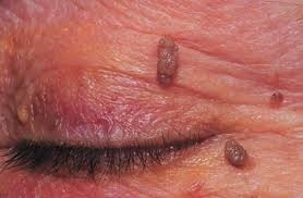 Ha neked is vannak ilyen csüngő anyajegyeid, erről feltétlenül tudnod kell!