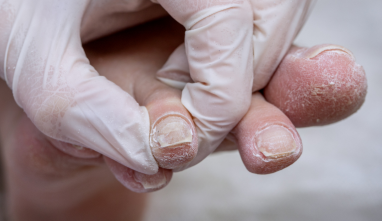 Ha ilyen a körmöd, fordulj orvoshoz - komoly betegség tünete is lehet!