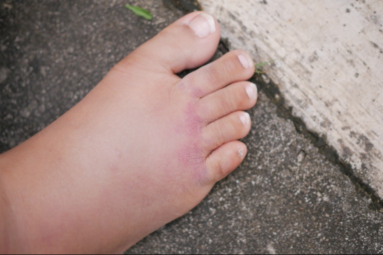 Tüdőödéma korai jel – Ha ezt tapasztalod, azonnal hívj mentőt!