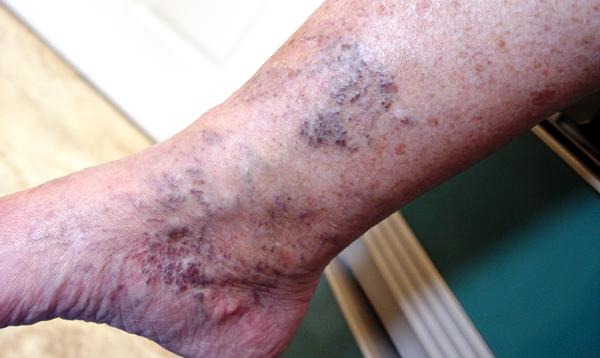 17 tünet a lábon, ami jelzi, hogy nagy a baj