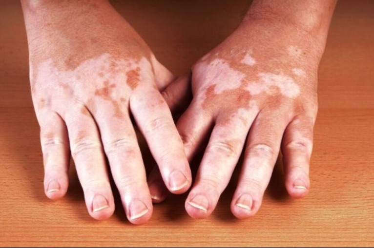 13 trükk, amikkel eltüntethetjük a bőr barna elváltozásait – Már 2 hét után látható eredmény!