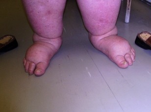 10 gyógymód a duzzadt lábakra, amit a tested meg fog köszönni neked